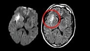 Kernspintomografie-Bild eines Gehirns nach einem Schlaganfall. © NDR 