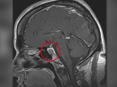 Abenteuer Diagnose Akromegalie Ndr De Ratgeber Gesundheit