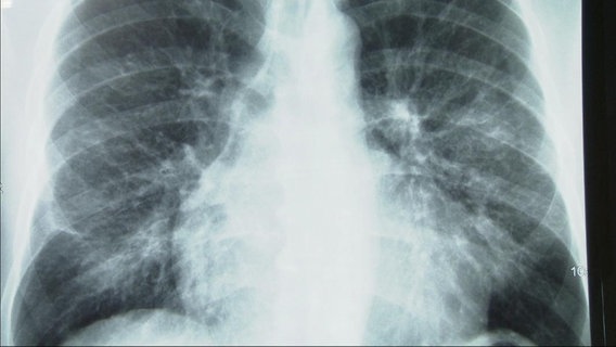 Röntgenbild eines Thorsos.  