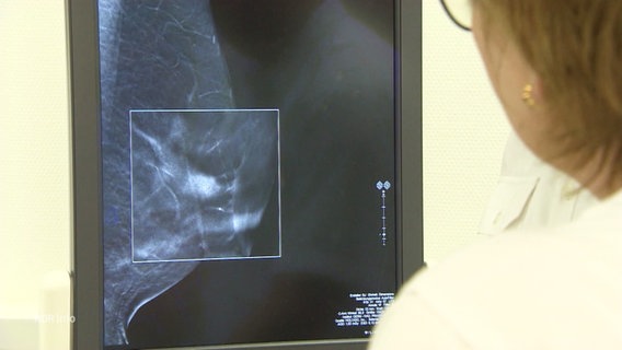 Eine Ärztin betrachtet das Röntgenbild einer weiblichen Brust und sucht nach Hinweisen auf Brustkrebs. © Screenshot 