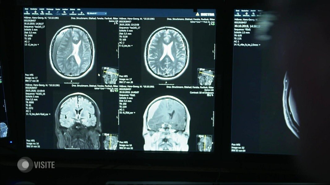 Bluterguss Im Gehirn So Tuckisch Ist Das Subduralhamatom Ndr De Ratgeber Gesundheit