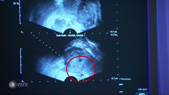 Ein Ultraschallbild zum Erkennen von Prostata-Krebs.  