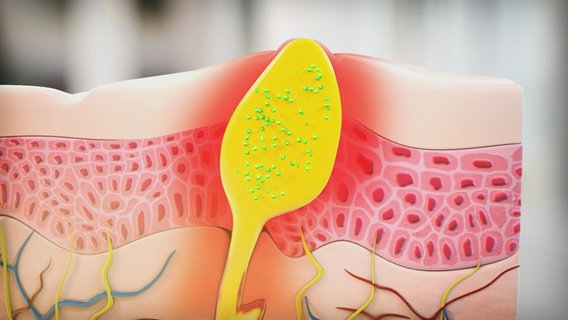 Pickel Mit Hartem Kern / Patientengeschichte Hauttumor Tarnt Sich Als Pickel Haz Hannoversche Allgemeine / Harter pickel entwickelt, wenn abgestorbene hautzellen, talg und bakterien der hautoberfläche gelangen.