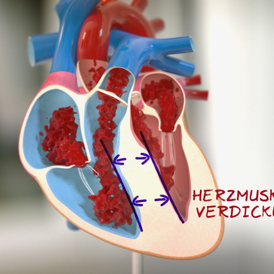 Herzmuskelverdickung Erkennen Und Behandeln Ndr De Ratgeber Gesundheit