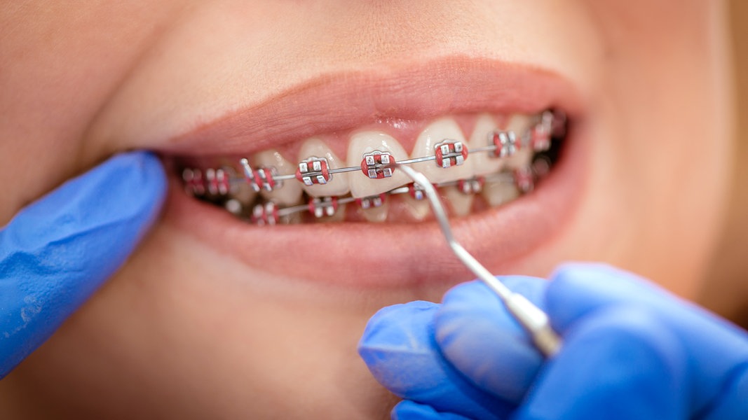 Zähne mit Zahnspange