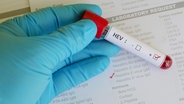 Ein Blutröhrchen vor einem Formular mit der Aufschrift HEV © fotolia.com Foto:  jarun011