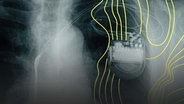 Auf dem Röntgenbild eines Brustkorbs ist ein implantierter Herzschrittmacher zu erkennen © picture alliance Foto: Stefan Sauer