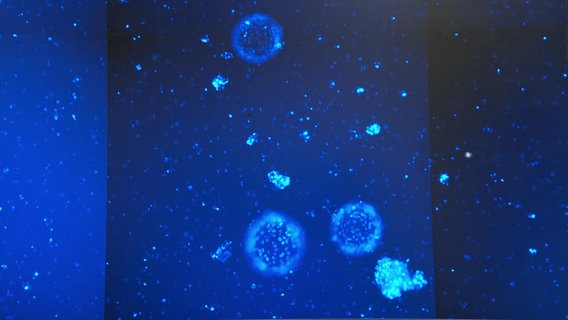 Ein Display zeigt Tumorzellen im Bauchwasser. © NDR Foto: NDR