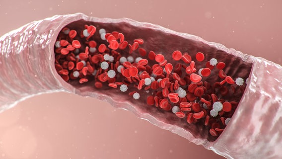 An artery that has red blood platelets flowing through it and white plaque that causes the artery to harden.  © colourbox photo: -