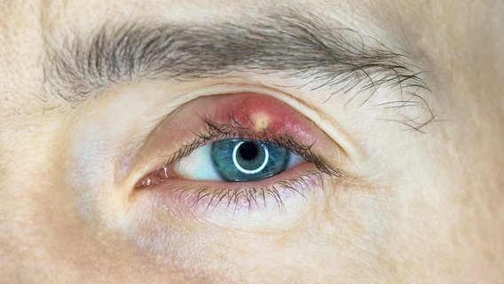 Nahaufnahme eines entzündeten Augenlides. © Colourbox Foto: -