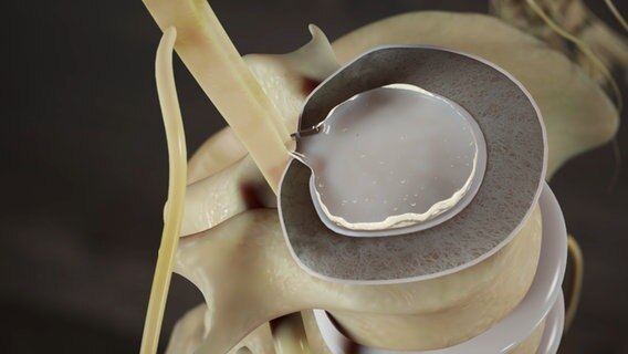 Schematische Darstellung: Bandscheibe, die zum Rückenmark hin ausgestürlpt ist. © NDR 
