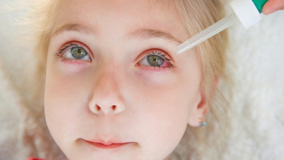 Gesicht eines Kindes mit gerötetem Auge, das Augentropfen erhält © IMAGO/Panthermedia Foto: Panthermedia