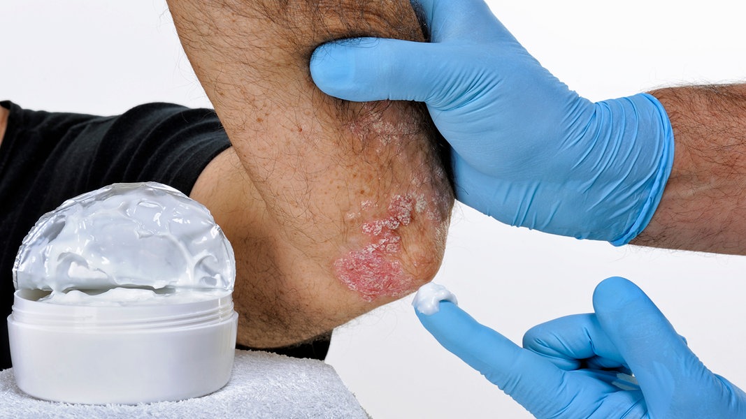 Schuppenflechte (Psoriasis): Symptome, Behandlung Und Ursachen | NDR.de ...