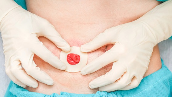 Stoma-Patient zeigt mit Fingern die Öffnung an der Bauchdecke an die ein künstlicher Darmausgang angebracht wird. © IMAGO/ Depositphotos Foto: Nataliya Korchmar