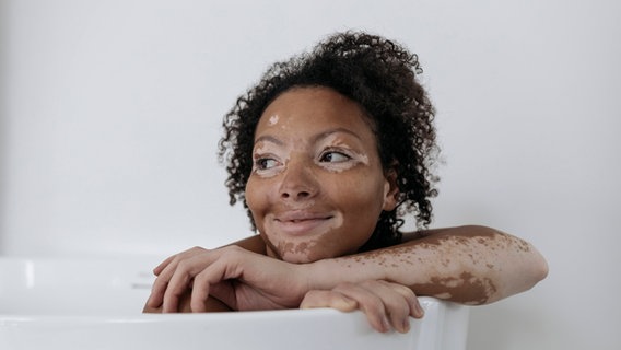 Vitiligo: Frau mit weißen Flecken auf der Haut. © IMAGO/ Westend61 Foto: Svetlana Iakusheva